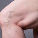 Las venas varices aparecen pro permanecer mucho tiempo sentado o de pie.