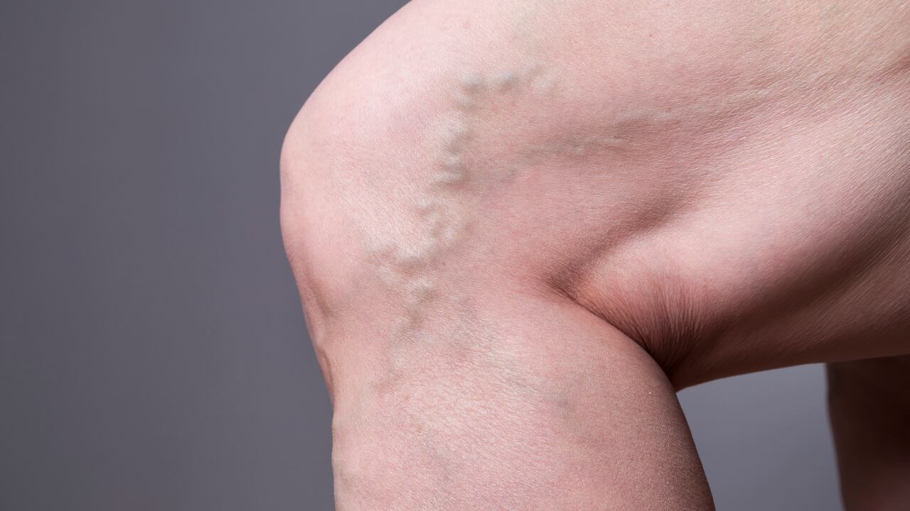 Las venas varices aparecen pro permanecer mucho tiempo sentado o de pie.