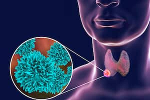 Cáncer de tiroides - Imagen de referencia