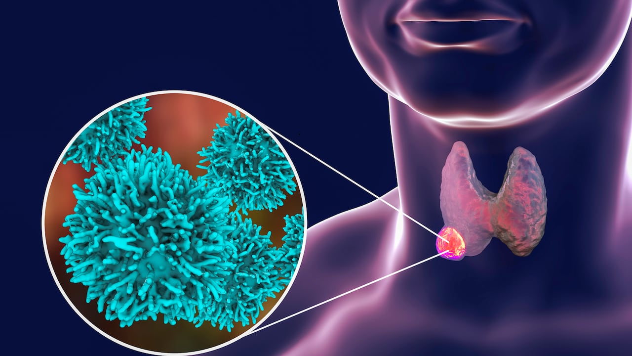 Las personas que tienen entre 25 y 65 años y son mujeres, tienen mayor riesgo de padecer cáncer de tiroides.