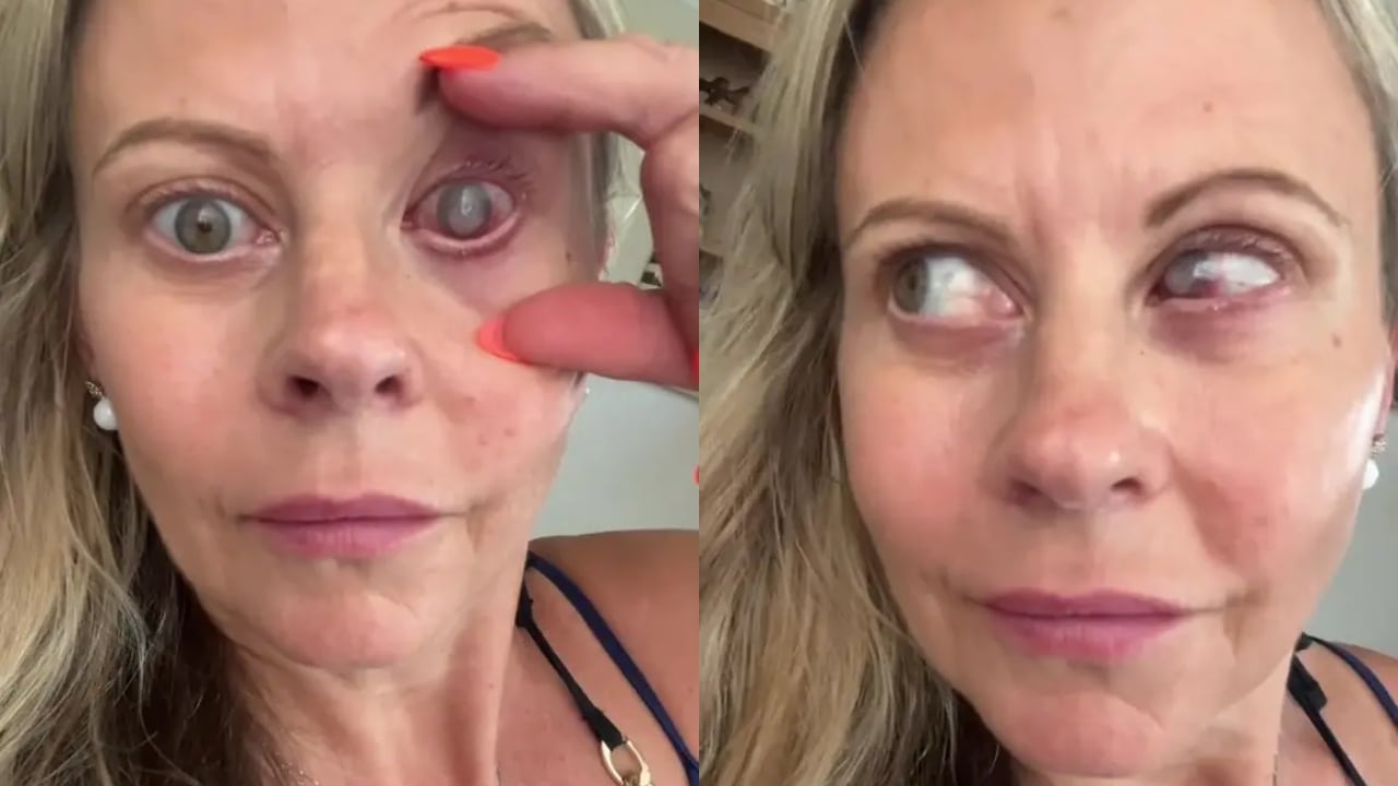 La mujer decidió contar su historia para prevenir sobre el cuidado con los lentes de contacto.