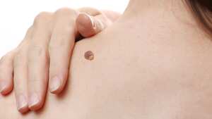 Las verrugas comunes son pequeños bultos granulares en la piel, que aparecen con mayor frecuencia en los dedos o en las manos, pero también puede presentarse en otras áreas del cuerpo.