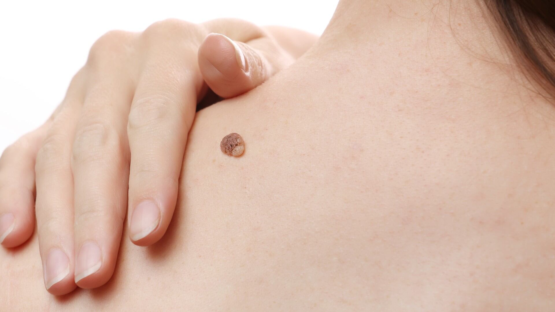 Las verrugas comunes son pequeños bultos granulares en la piel, que aparecen con mayor frecuencia en los dedos o en las manos, pero también puede presentarse en otras áreas del cuerpo.