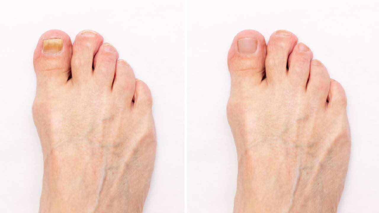 El problema en las uñas debe tratarse de raíz y puede tener varias causas.