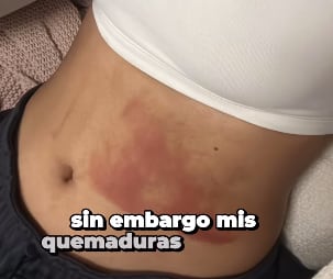 Ex Miss República dominicana  sufrió fuertes quemaduras por accidente