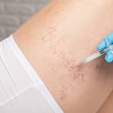 Este tema de salud se centra en las várices de las piernas, pero a veces se forman várices en otras partes del cuerpo.