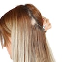 La alopecia femenina se caracteriza por la caída del cabello y afinamiento o pérdida de densidad.