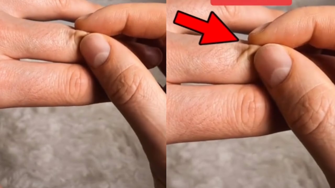 Una manera de realizar esta prueba es pellizcando la piel que se ubica sobre la unión entre las falanges medias y las falanges proximales.