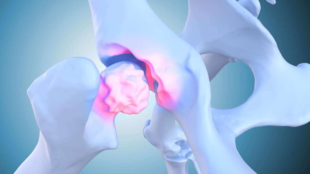 Si hay dolor fuerte en las caderas hay que tener en cuenta que puede ser un desgaste en la articulación al que se le debe prestar atención.