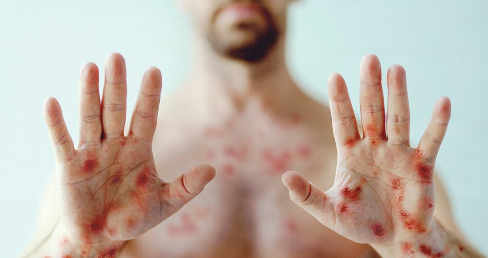 60.000 casos de viruela del mono se registran a nivel mundial según la OMS.