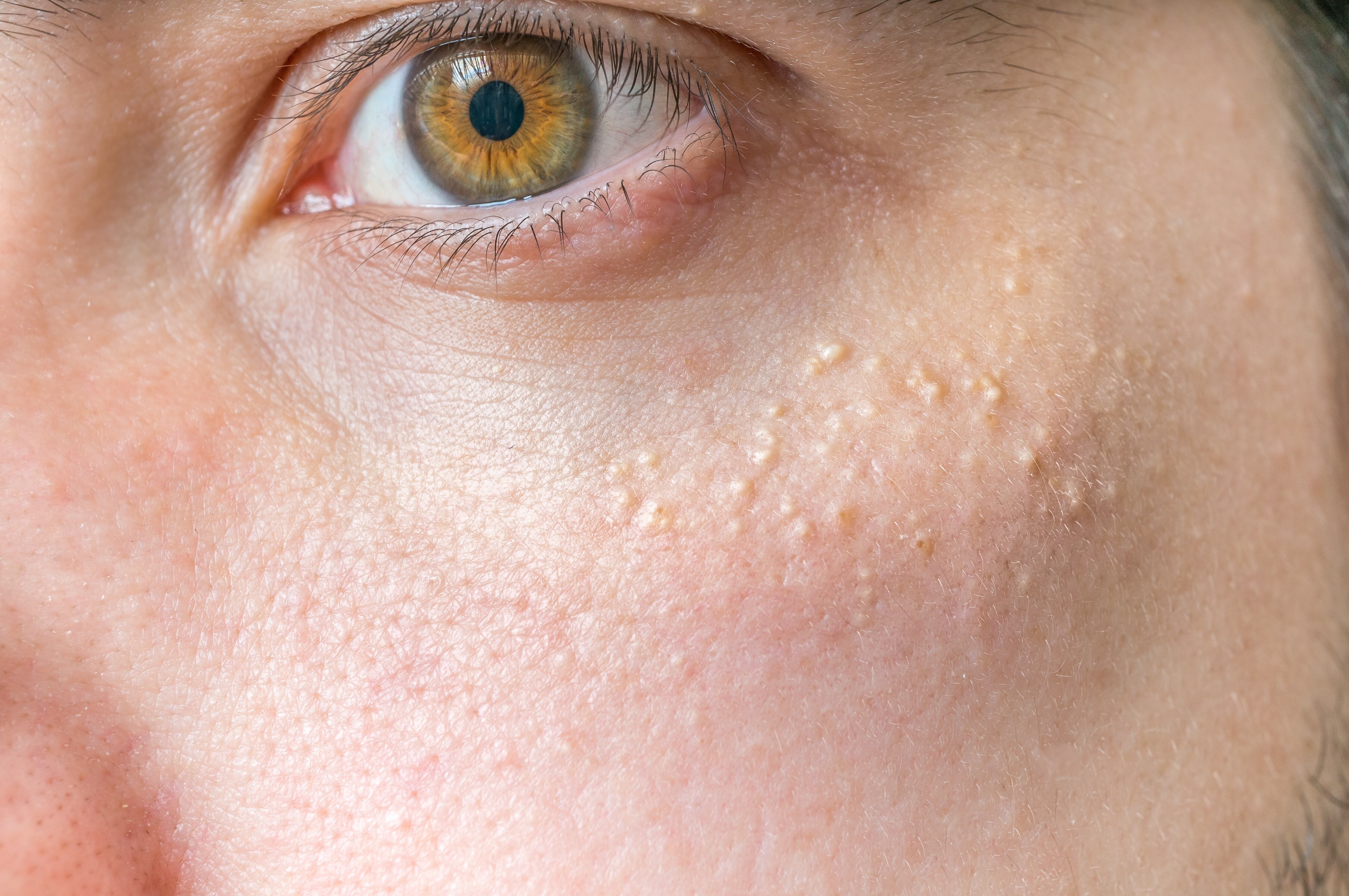 Milia (Milium) - pimples around eye on skin.