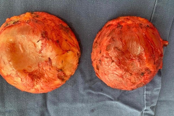 Implantes mamarios de Claudia Bahamón. Foto: Instagram @claudiabahamon.