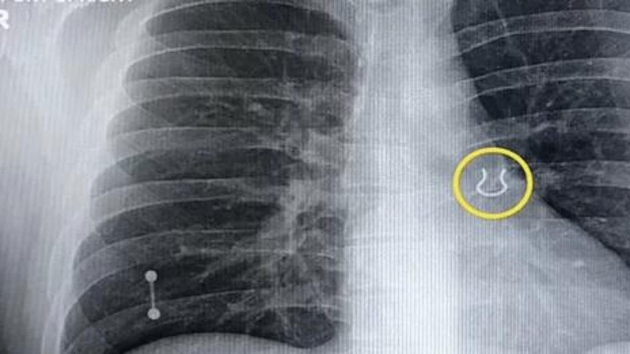 La tos y el dolor de espalda de Joey Lykins se debía a un piercing de nariz que había perdido hace cinco años y se encontraba alojado su sistema respiratorio.