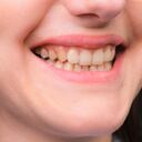 Los dientes amarillos se pueden generar por múltiples factores.