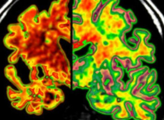Actualmente seguimos investigando e innovando en otras enfermedades complejas como el alzhéimer.
