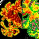 Hablar dos o más idiomas parece proteger al cerebro de los síntomas de Alzheimer.