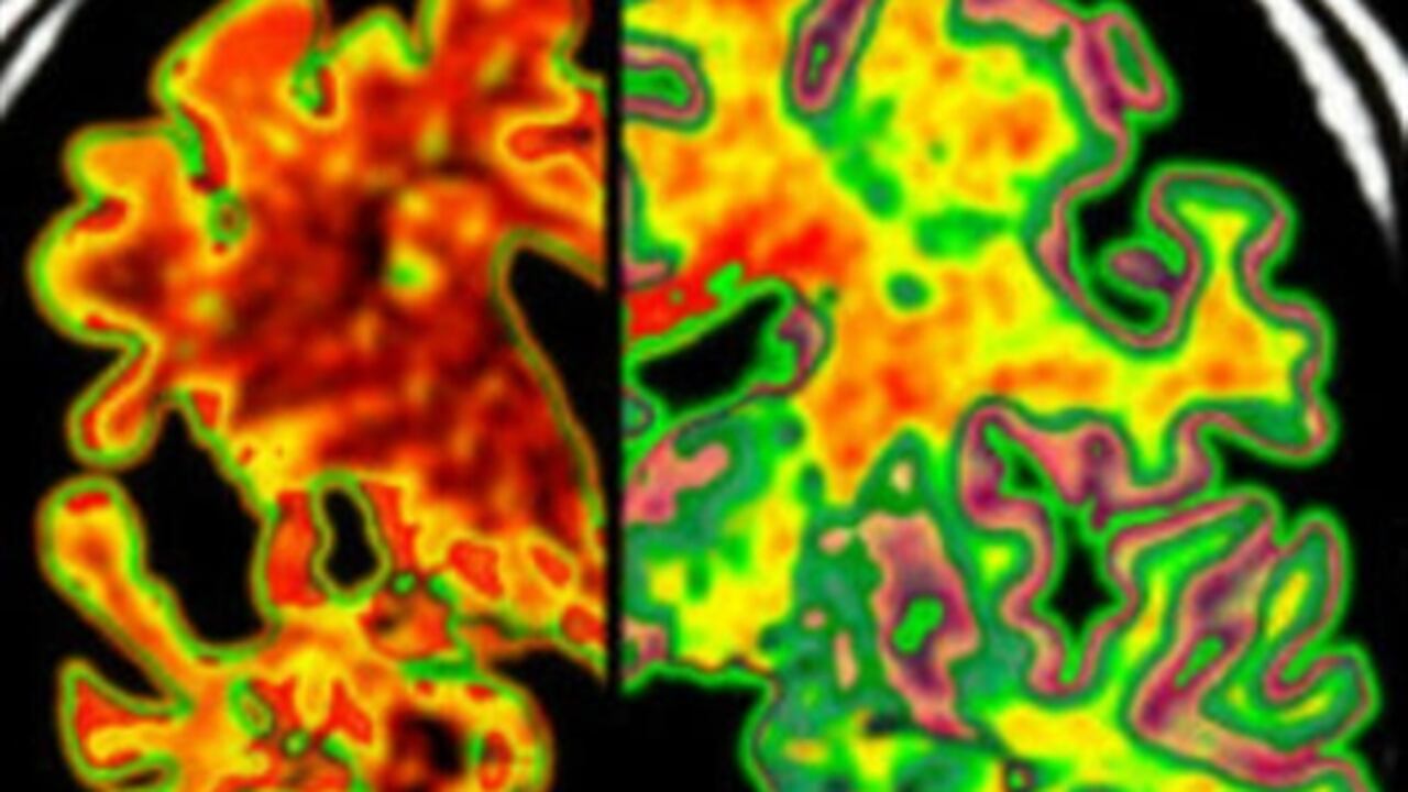 Hablar dos o más idiomas parece proteger al cerebro de los síntomas de Alzheimer.