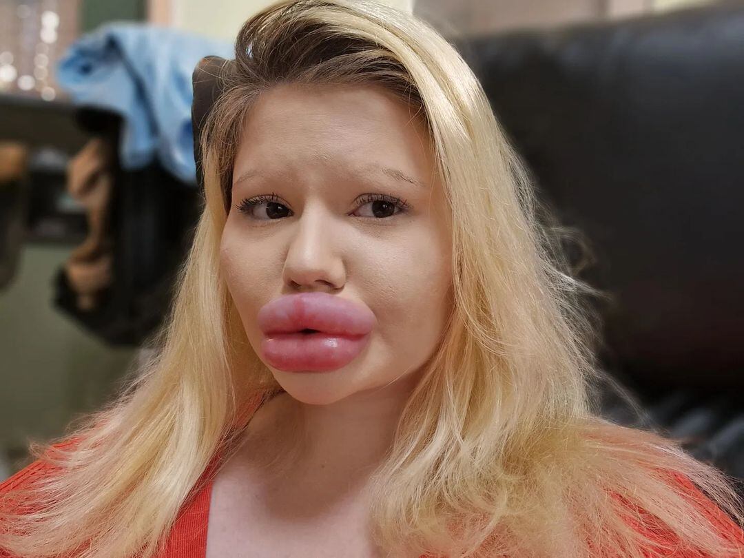 La joven también suela con alcanzar el récord de ser la mujer con los pómulos más grandes del mundo.