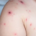 OMS cita a reunión urgente por propagación mundial de la viruela del mono