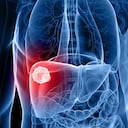 Este es el cáncer de hígado más común.