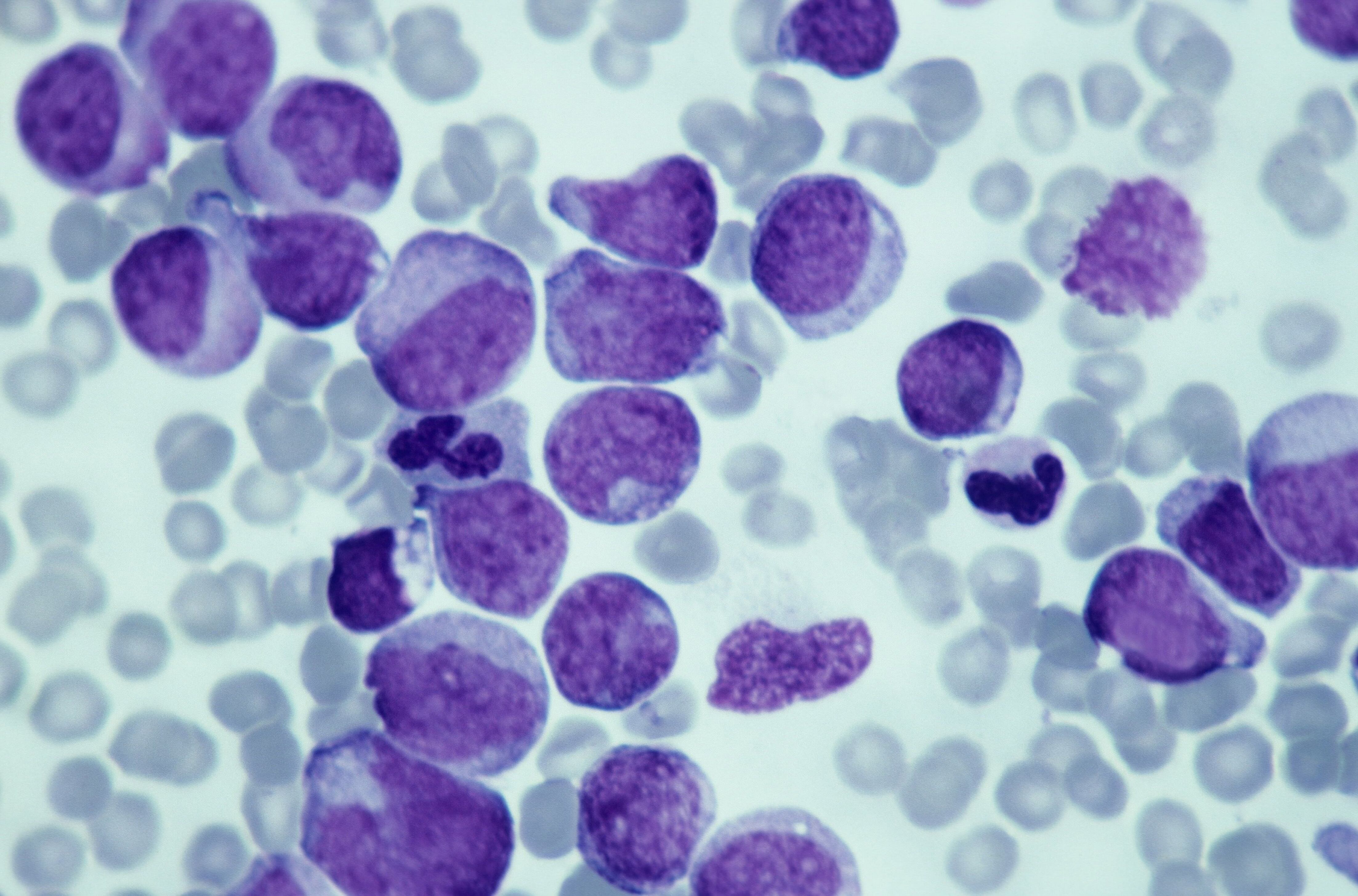 Leucemia