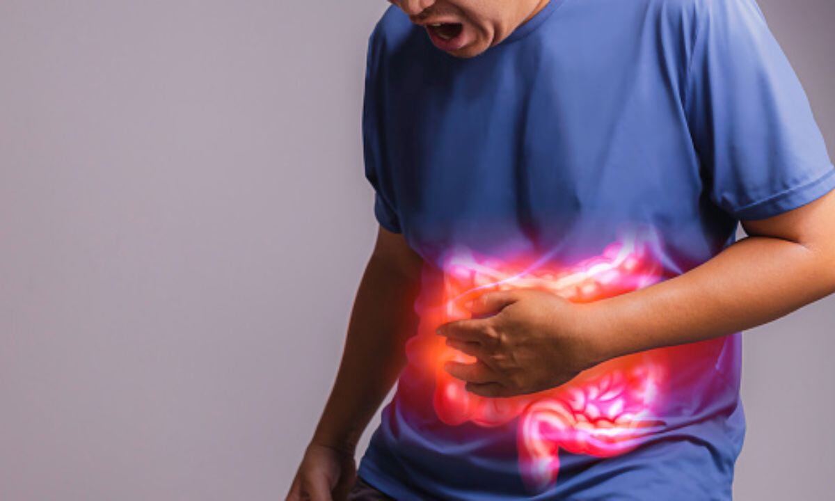 Síndrome del colon irritable.