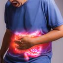 Síndrome del colon irritable.