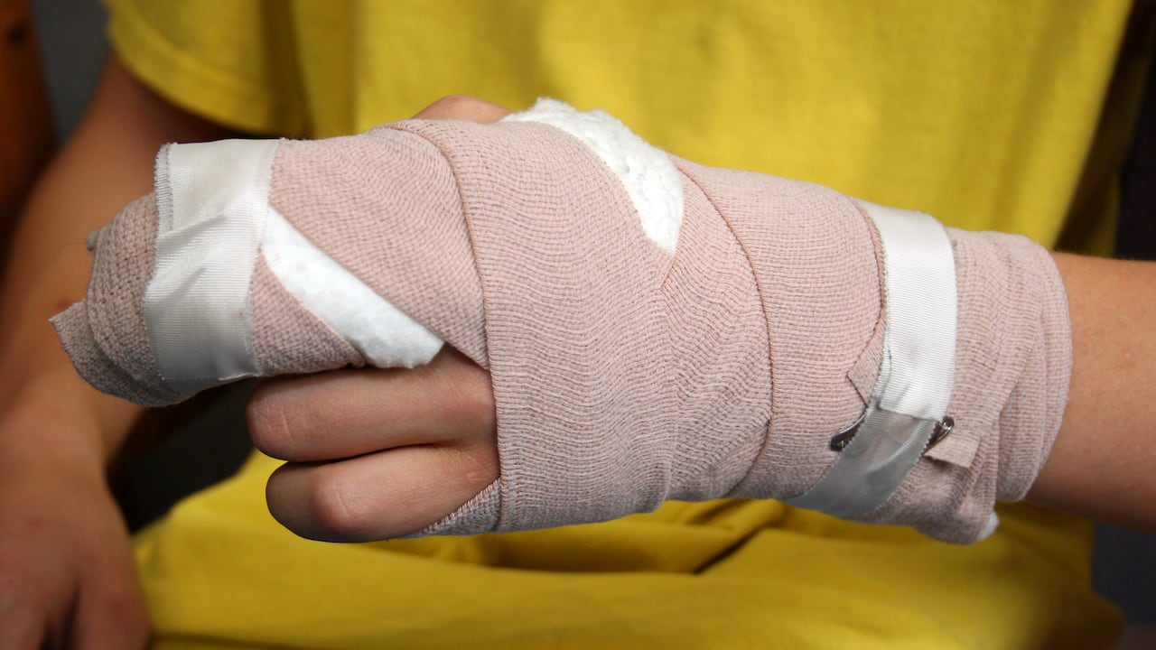 La cantidad de quemados con pólvora entre diciembre y lo corrido de enero es de 930 personas.