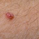 close-up wart on a hairy human body, front and background blurred with bokeh effect