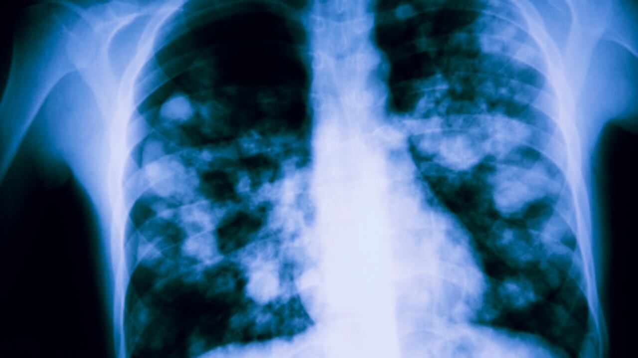 Un edema pulmonar ocurre cuando los alvéolos pulmonares se llenan de líquido.