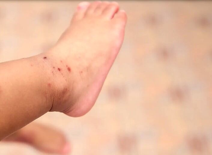 Para tranquilidad de los mayores esta infección es benigna