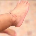 Esta es una infección viral muy común en los niños