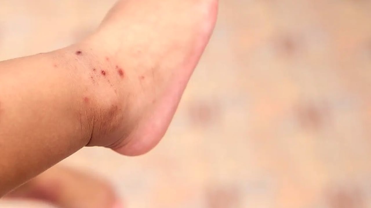 Esta es una infección viral muy común en los niños.