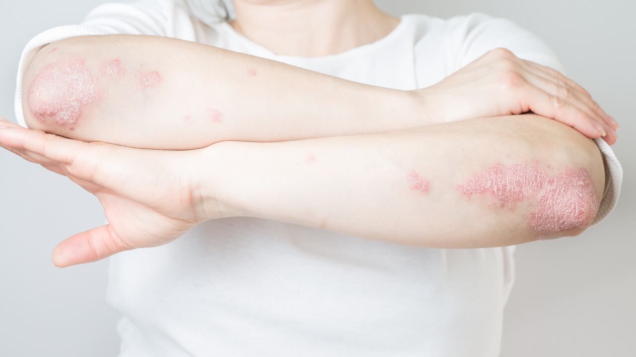 La fisioterapia y la terapia ocupacional podrían aliviar el dolor y facilitar hacer las tareas diarias.