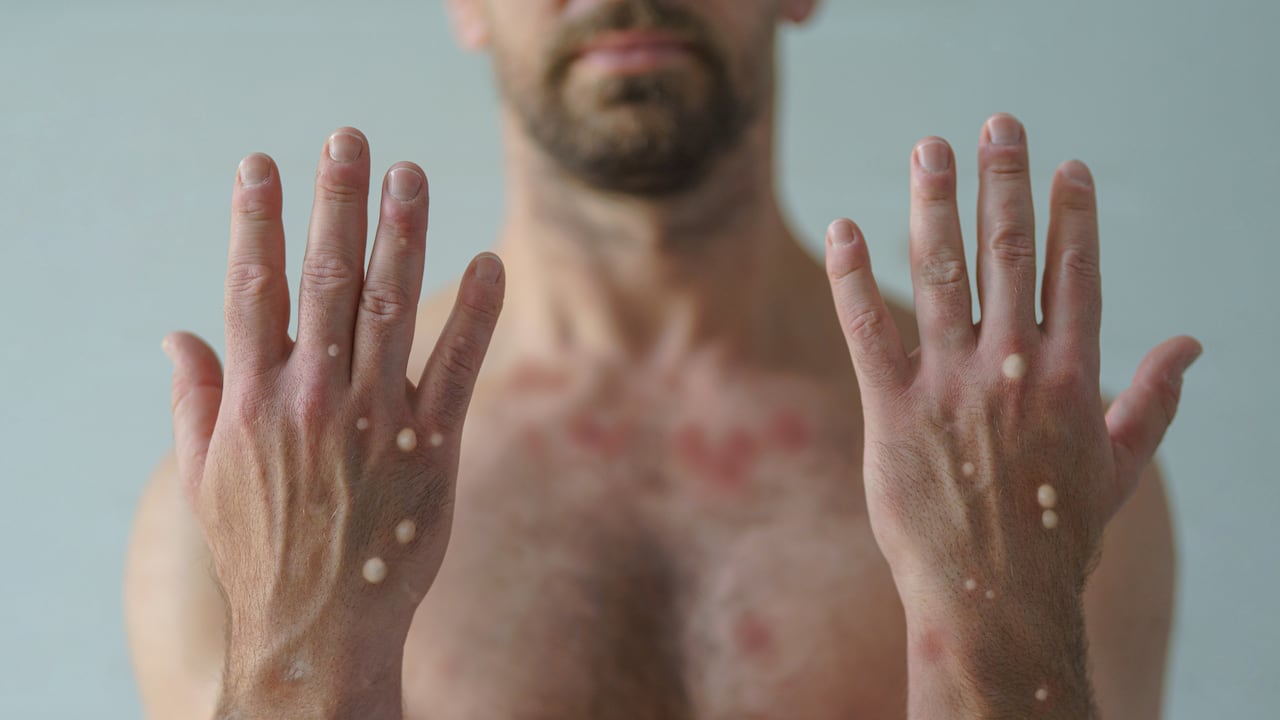 Del total de casos de la viruela del mono en el mundo, solo el 9,2 % ha requerido hospitalización.