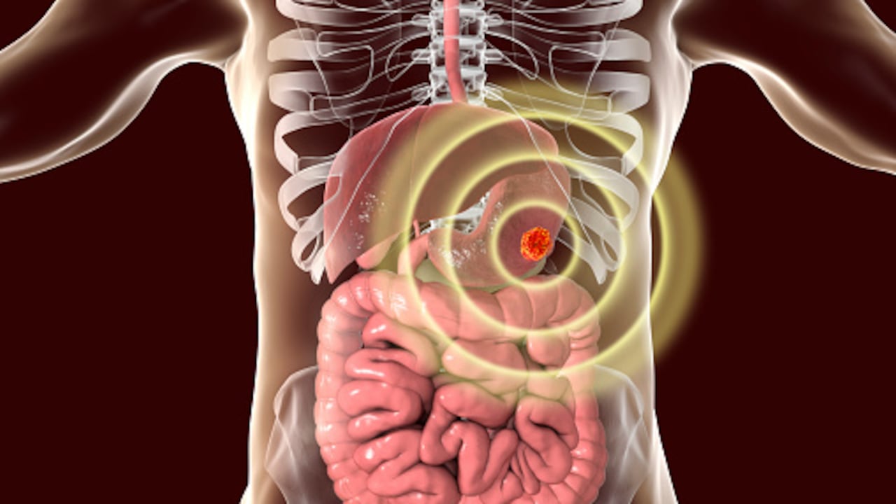 El cáncer de estómago empieza cuando las células en este órgano crecen de manera descontrolada.