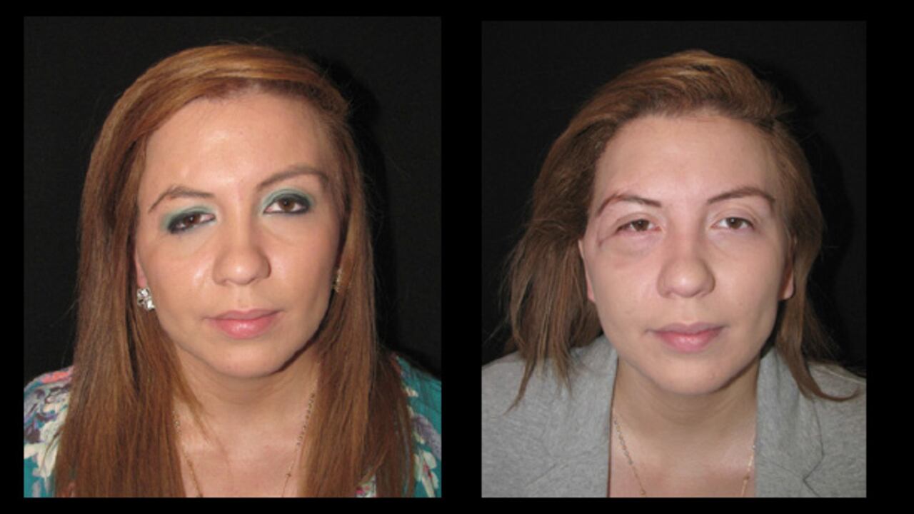 Jennifer Rodríguez perdió parte del cráneo y se desfiguró la cara en un accidente de tránsito. La cirugía que se hizo en Bogotá le devolvió la simetría a su rostro.