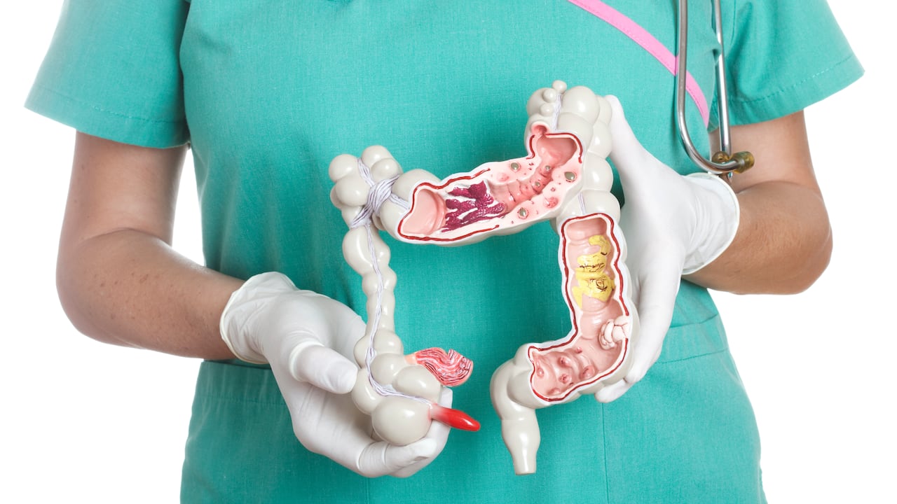 Una alimentación balanceada y ejercicio constante también se requieren para mantener un colon sano.