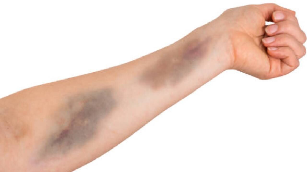 Trombocitopenia (Imagen de referencia).