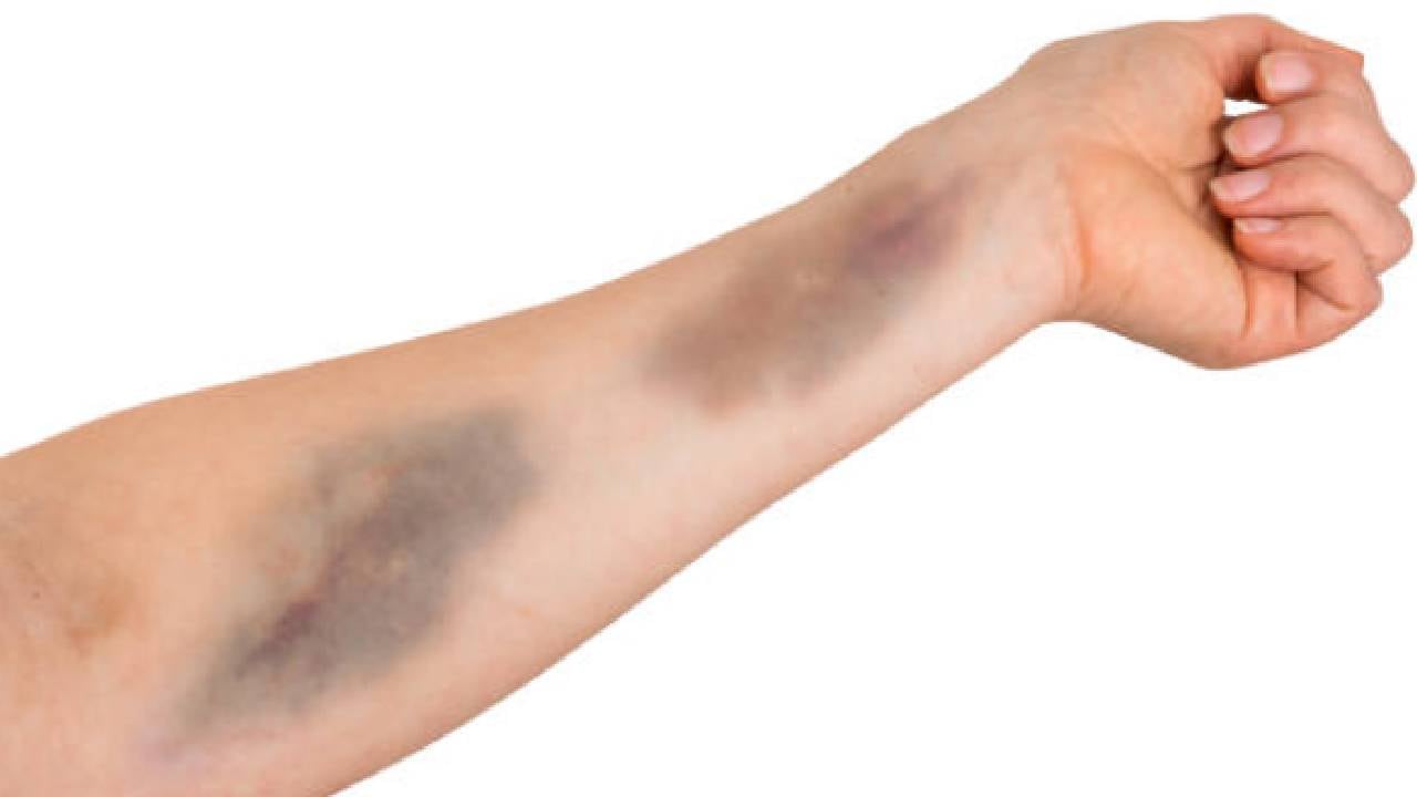 Trombocitopenia (Imagen de referencia).