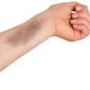 Trombocitopenia (Imagen de referencia).