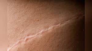 Miel, sábila y lavanda, están entre los ingredientes para hacer cremas que eliminan las cicatrices. Foto: GettyImages.