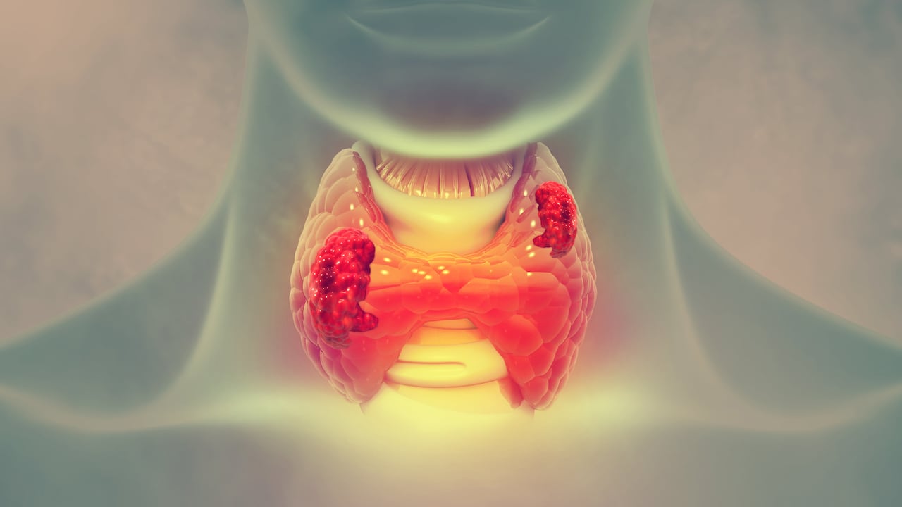 Cáncer de tiroides - Imagen de referencia