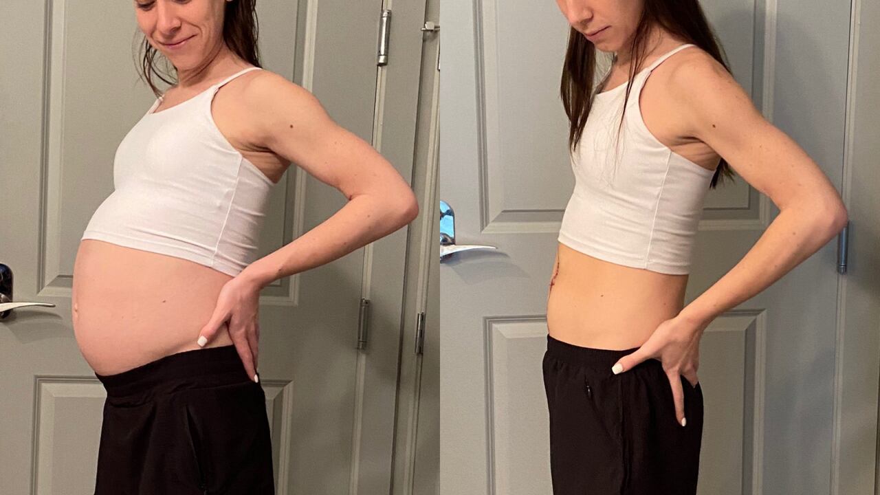 El tumor de Amanda Shoultz tenía 33 centímetros de ancho y pesaba 17 libras.