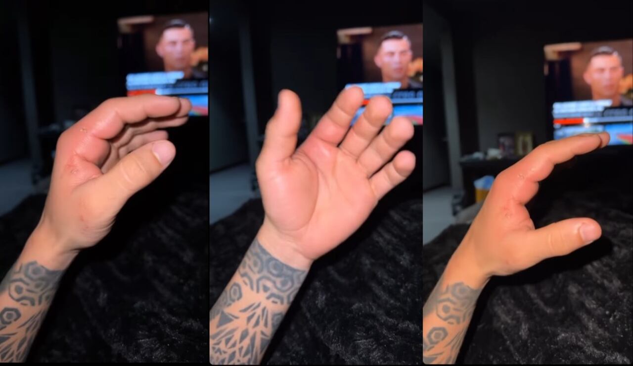 El creador de contenido plasmó el resultado de la mordida que recibió de uno de sus perros.