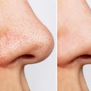 Los poros se tapan de impurezas y suciedad.