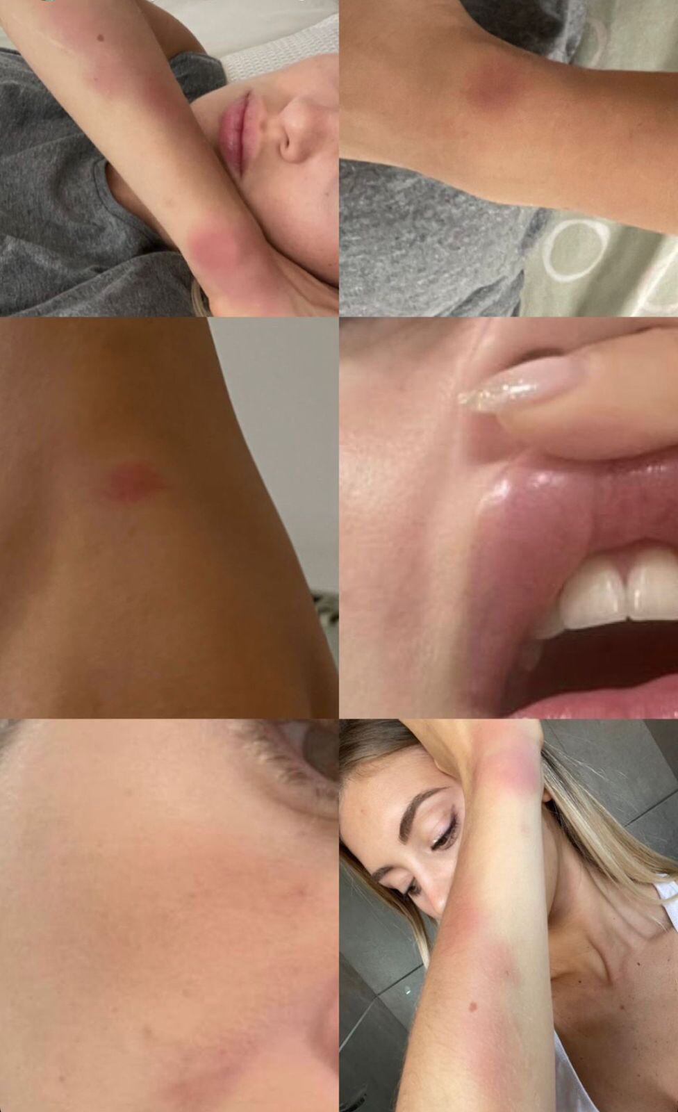 Heridas por la agresión física de Lautaro Acosta a su expareja Ludmila Isabella.