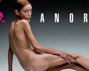 La modelo que apareció en carteles para una campaña de Benetton contra la anorexia en 2007, murió meses después.