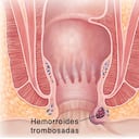 Coronal section of anal canal and lower rectum showing thrombosed hemorrhoid.