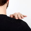 Entre las causas de la caspa se encuentran la piel seca, irritada o grasosa, sensibilidad a los productos para el cuidado del cabello.